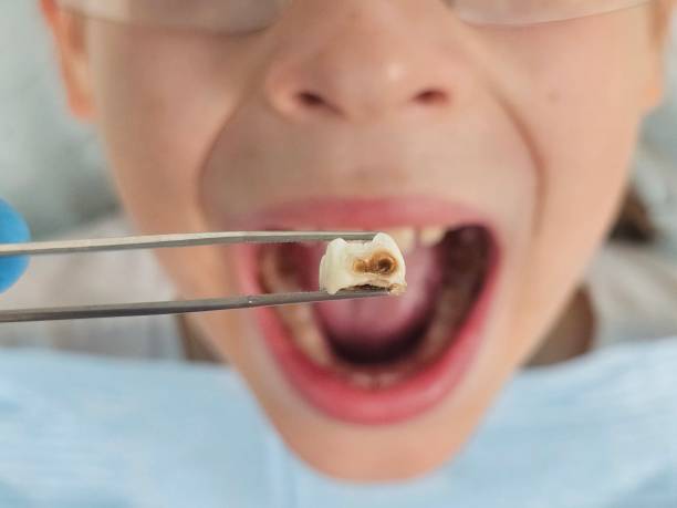 Best Urgent Tooth Repair  in Picnic Point, WA