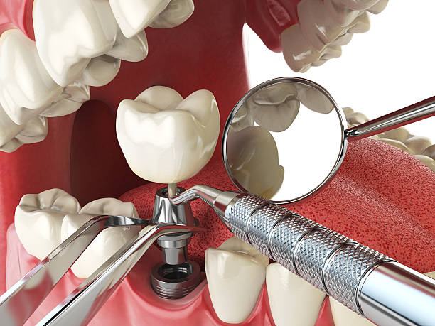 Tooth Infection Emergency Dentist in WA